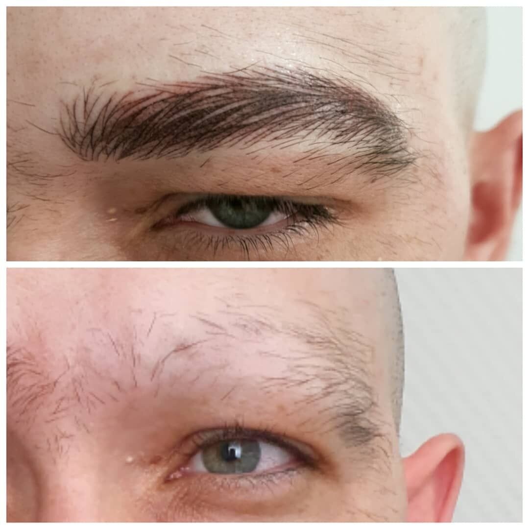 Алопеция - история борьбы за брови