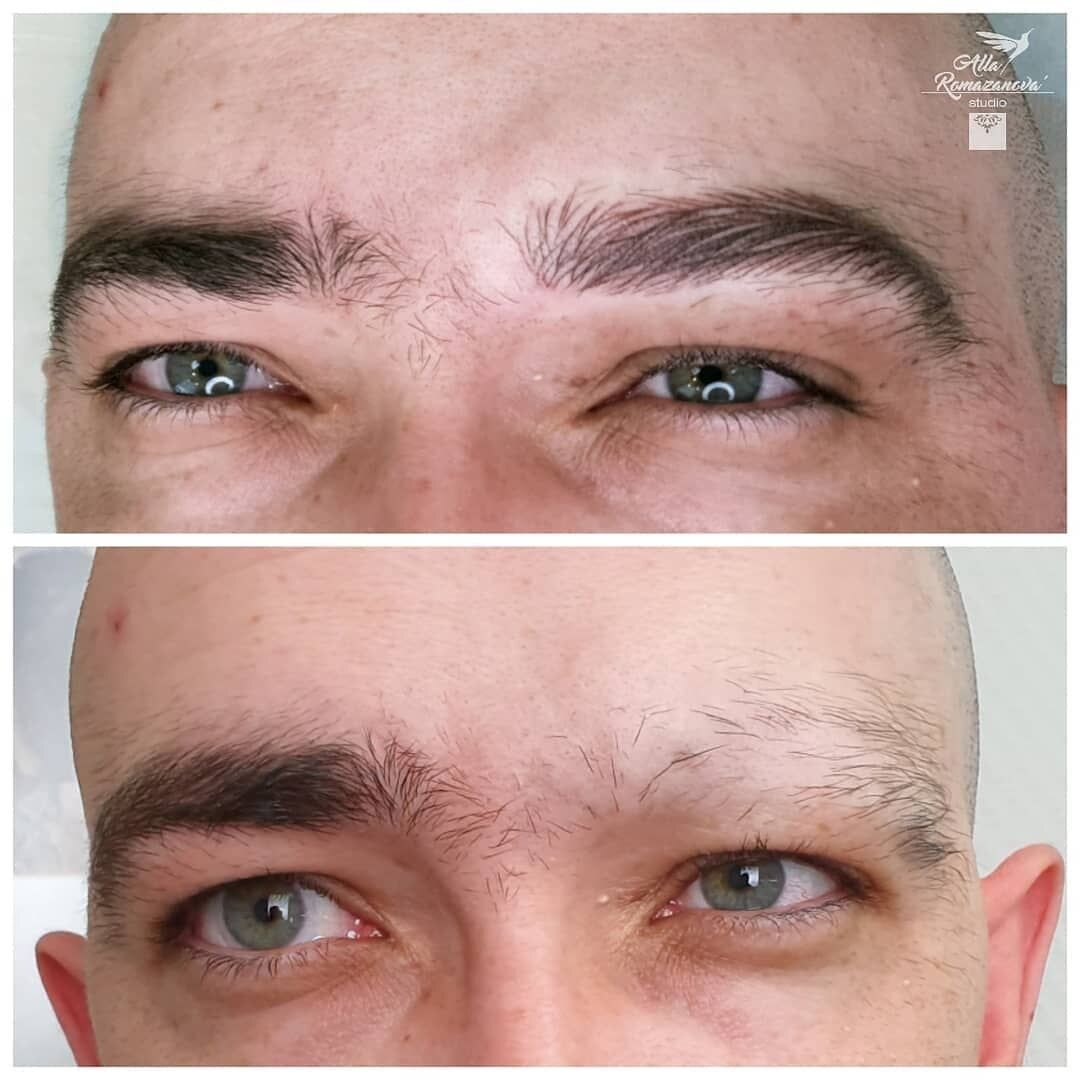 Алопеция - история борьбы за брови