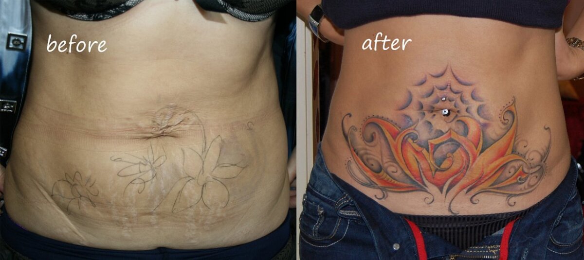 Новая глава истории моей борьбы со шрамами - следами жизни