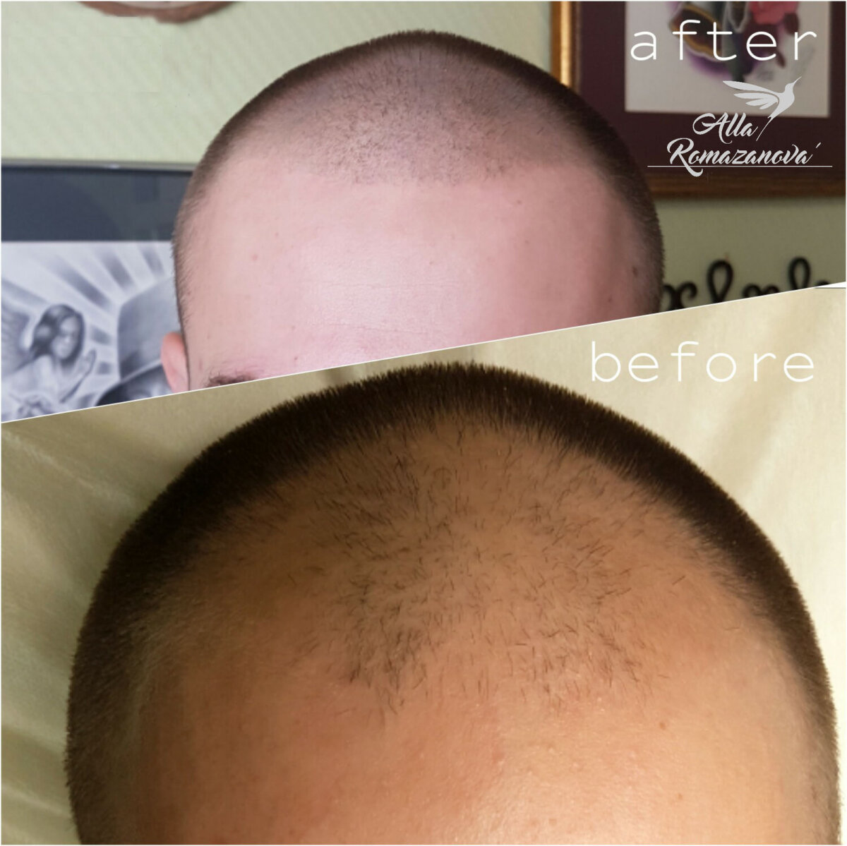 История моей борьбы с облысением, или что такое трихопигментация