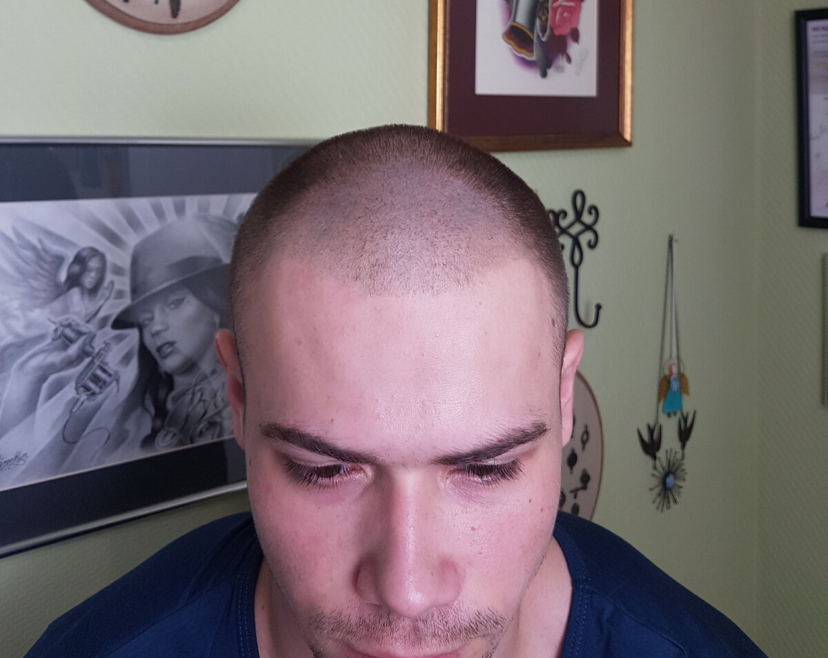 История моей борьбы с облысением, или что такое трихопигментация