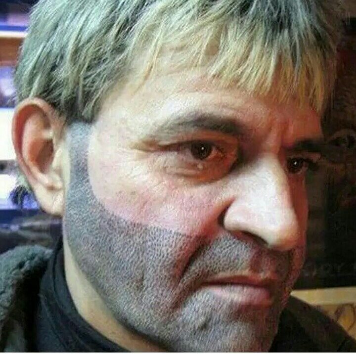 История моей борьбы с облысением, или что такое трихопигментация